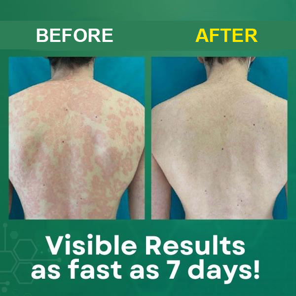 Psoriasis Cream (Original) – 20g